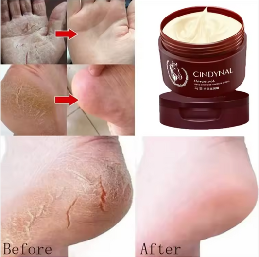 كريم تشققات القدمين واليدين – نعومة من أول استخدام