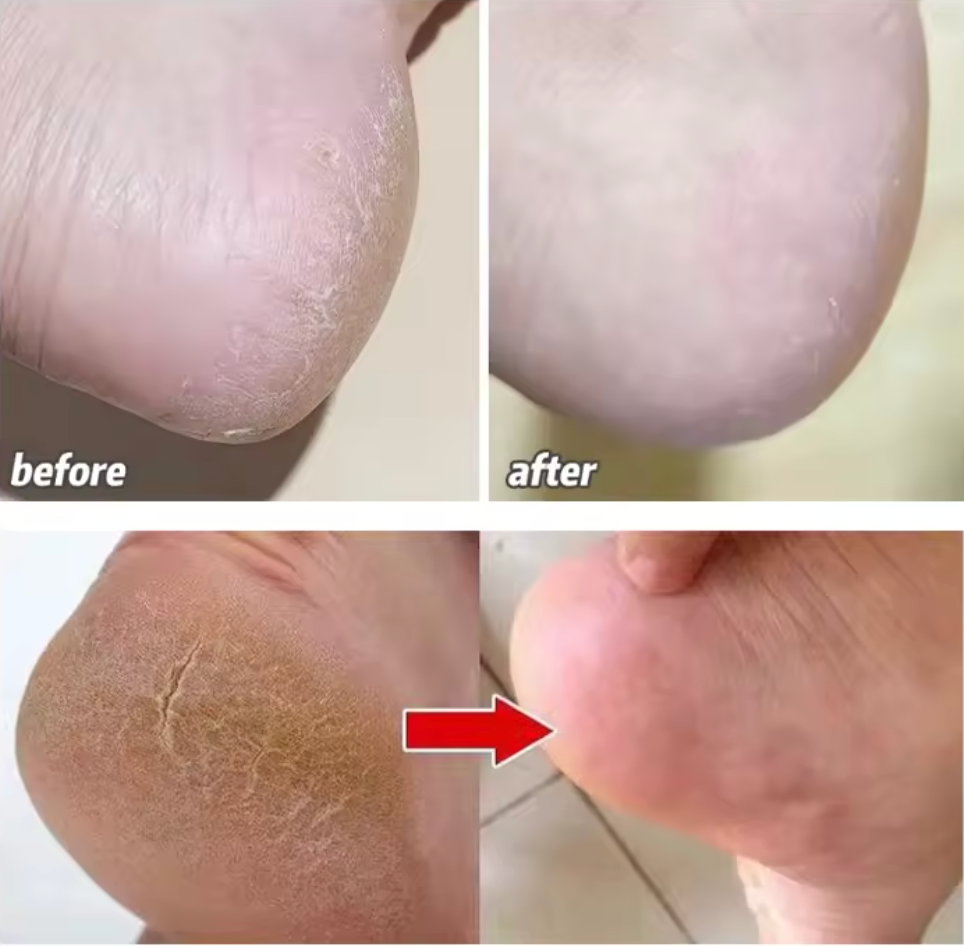 كريم الحرير العلاجي – لترميم وترطيب تشققات الجسم بزيت الحصان